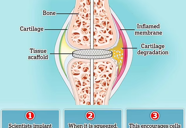 arthritis